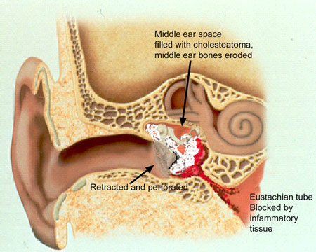 Colorful illustration of cholesteatoma and erosion of the mi
