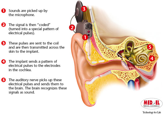 A colorful illustration of the inner ear and how the cochlea