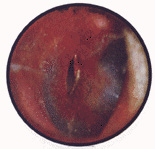 Close up photo of a small perforation in an eardrum