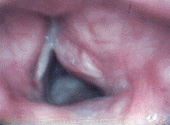 Close up of vocal folds and a Teflon granuloma